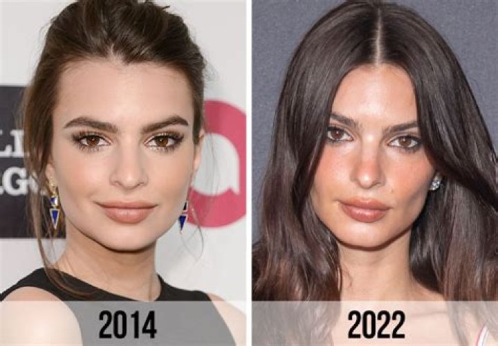 Unveiling The Truth And Impact Of Emily Ratajkowski's Surgery